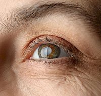 Cataracts: Prevention and Treatment